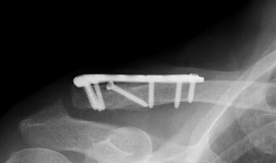 Lateral Clavicle Nonunion ORIF